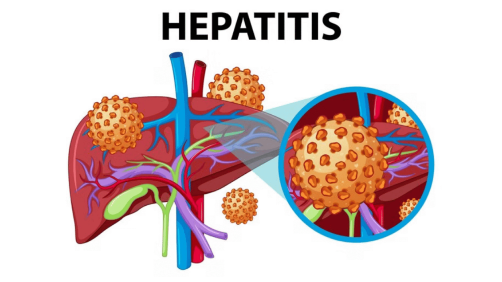 Main Types of Hepatitis and Their Differences