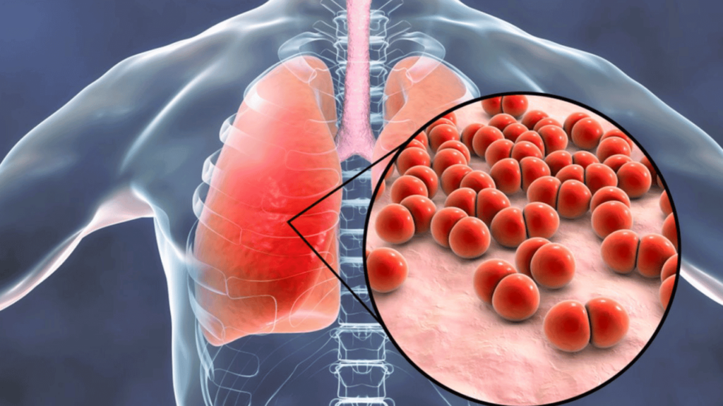 What Causes Pneumonia