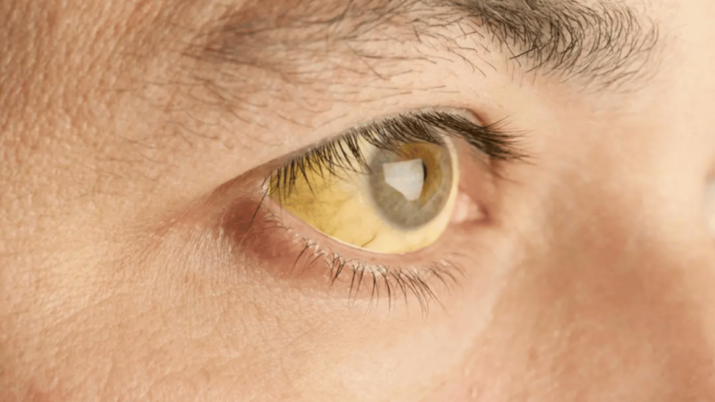 What Is Yellow Fever
