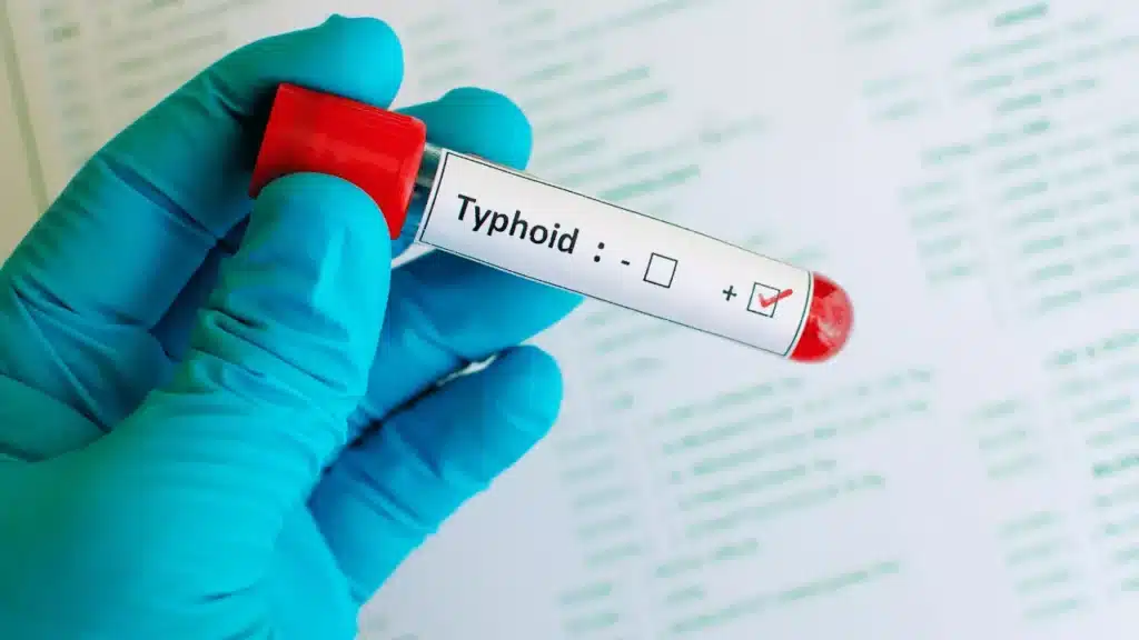 how-typhoid-fever-spreads-in-bali