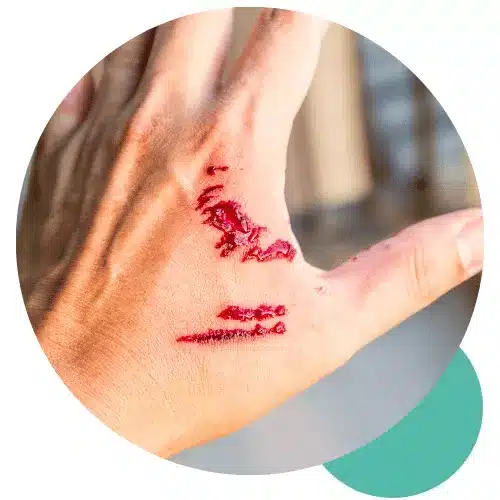 rabies-and-post-exposure-prophylaxis-bali-fi