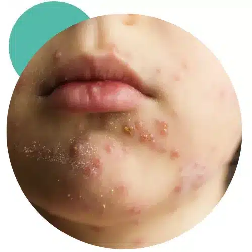 varicella-vaccine-fi