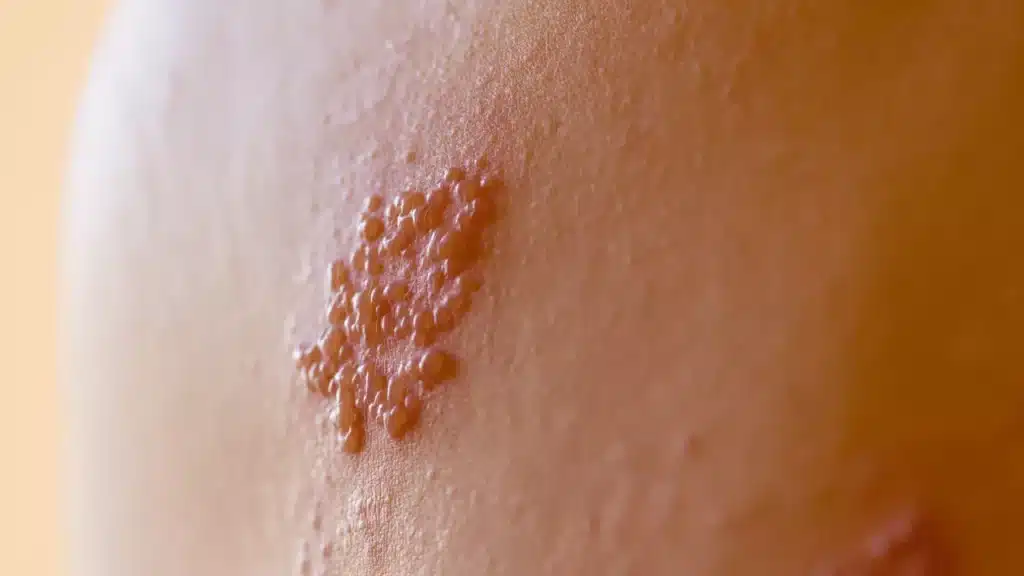 understanding-herpes-zoster