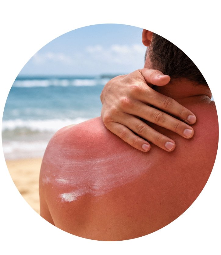 Got Sun Poisoning in Bali What to Do for Sunburn Relief