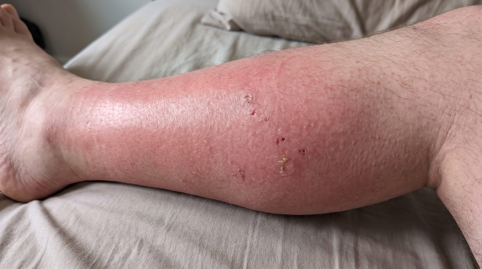 Warning Signs of a Tropical Infection Bali